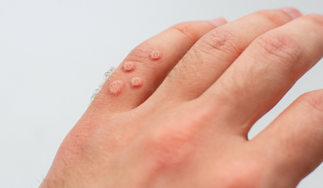 Common warts on hands